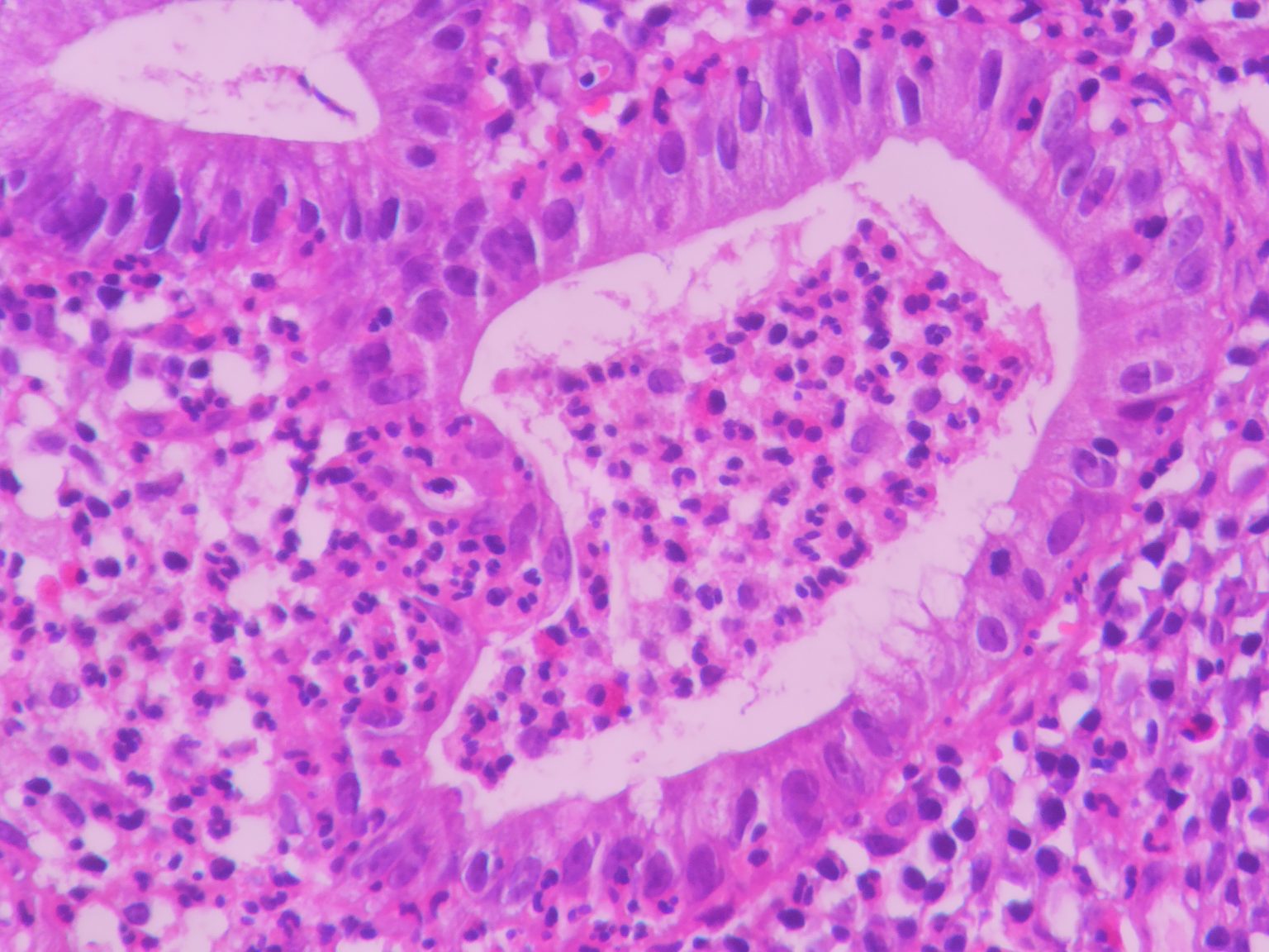 Ulcerative colitis – Histopathology.guru