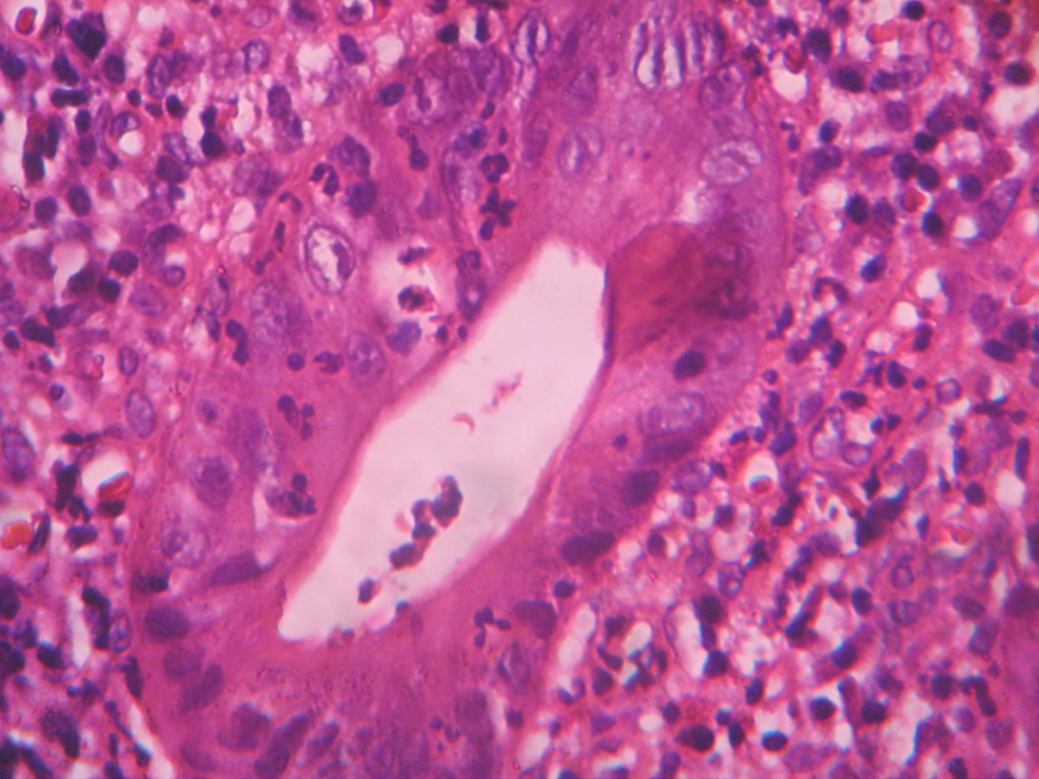 Ulcerative Colitis Histopathologyguru 8298