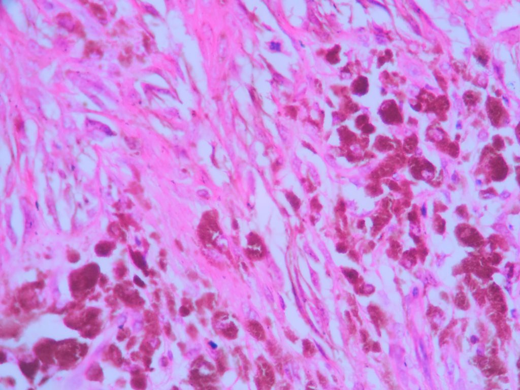 Melanoma – Histopathology.guru