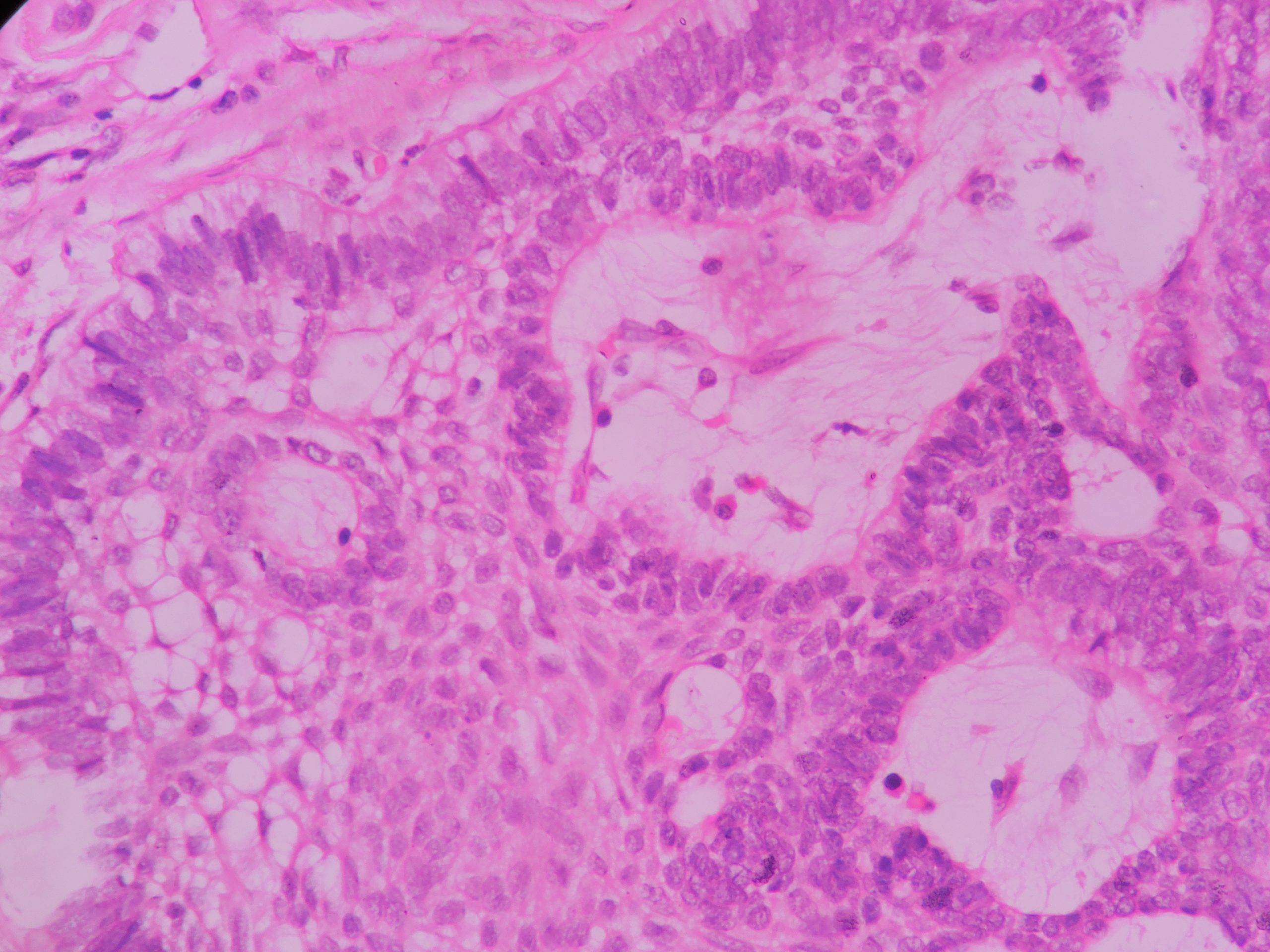 AMELOBLASTOMA – Histopathology.guru