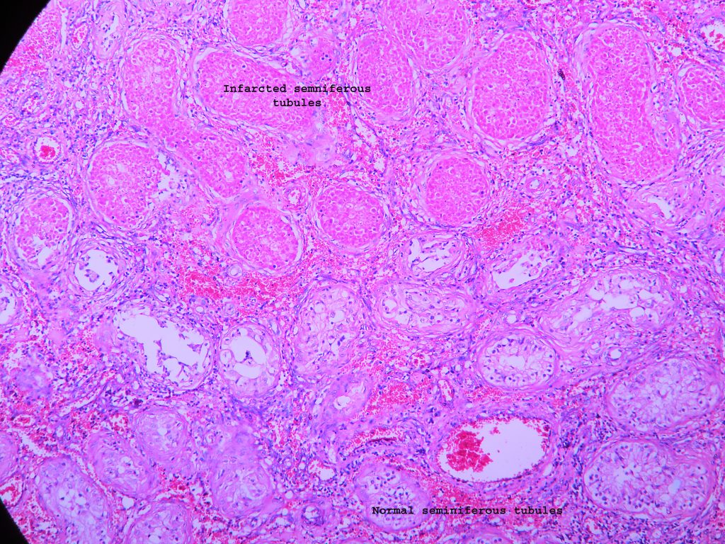 Coagulative necrosis – infarction testis – Histopathology.guru