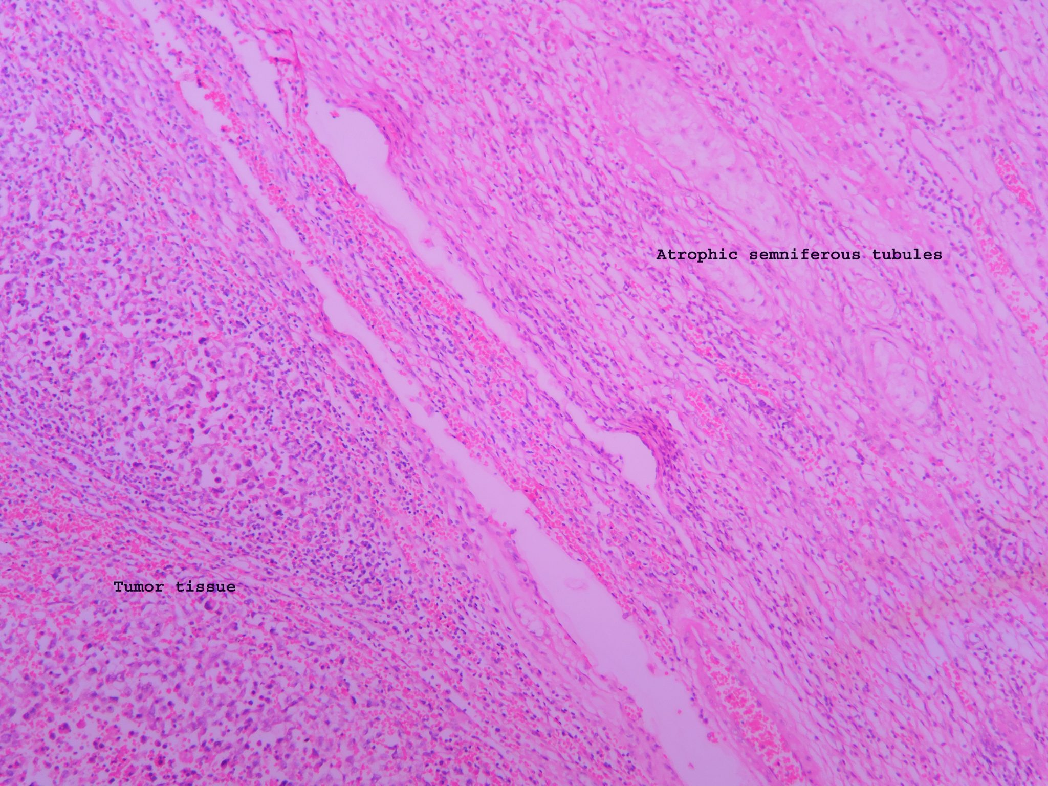 Seminoma – Histopathology.guru