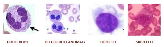 Peripheral smear – WBC – Histopathology.guru