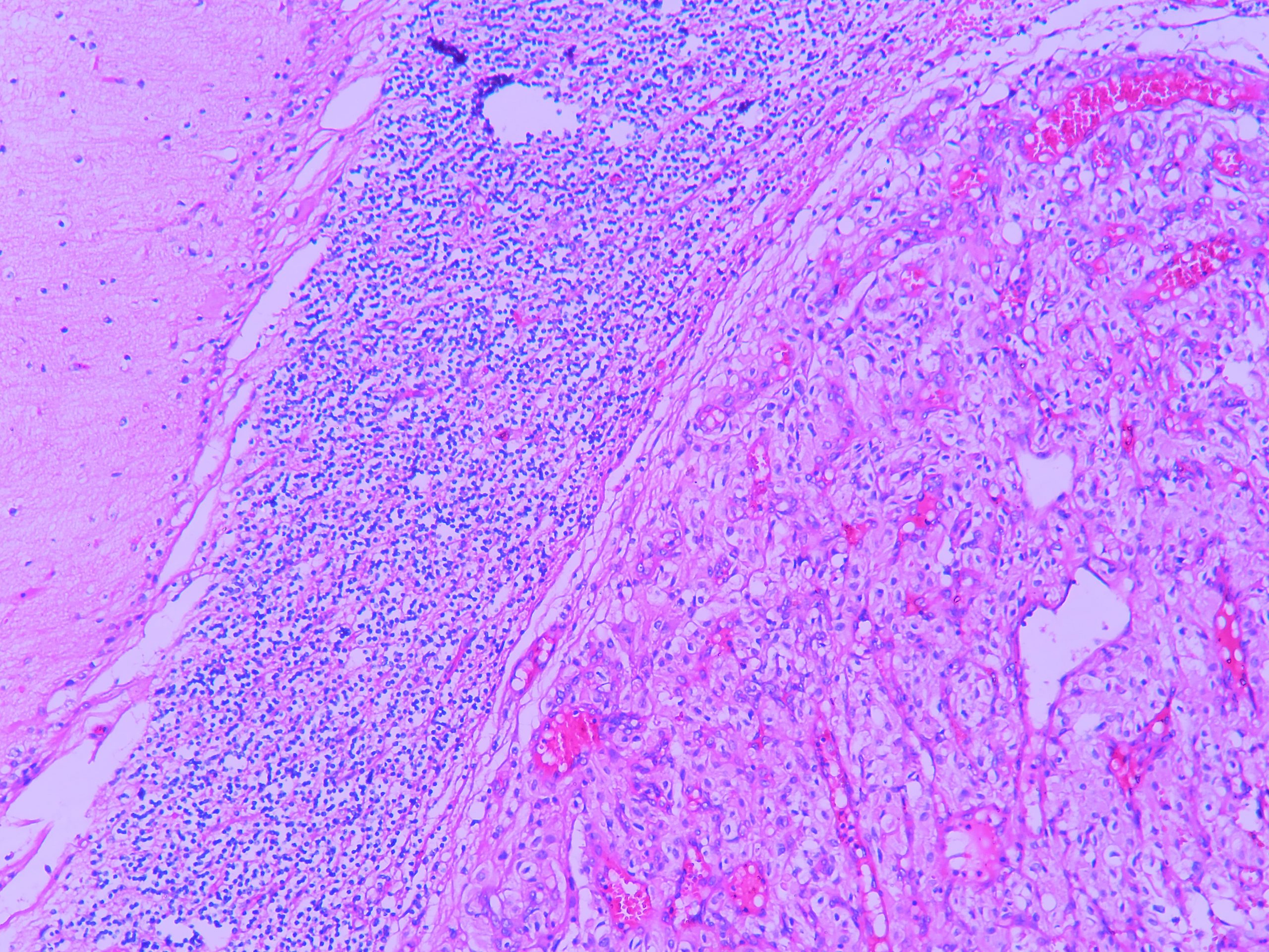 HAEMANGIOBLASTOMA – Histopathology.guru