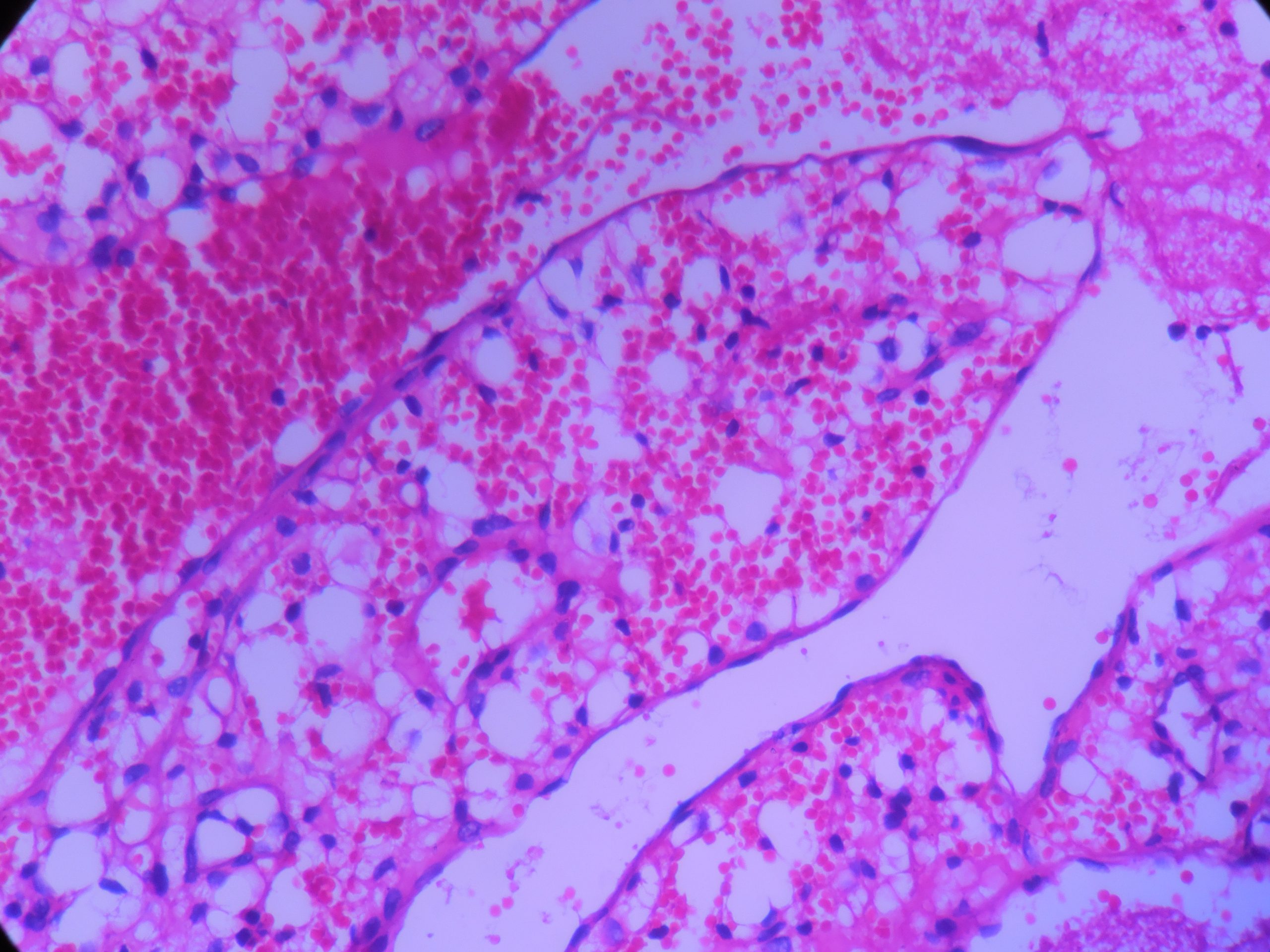 HAEMANGIOBLASTOMA – Histopathology.guru