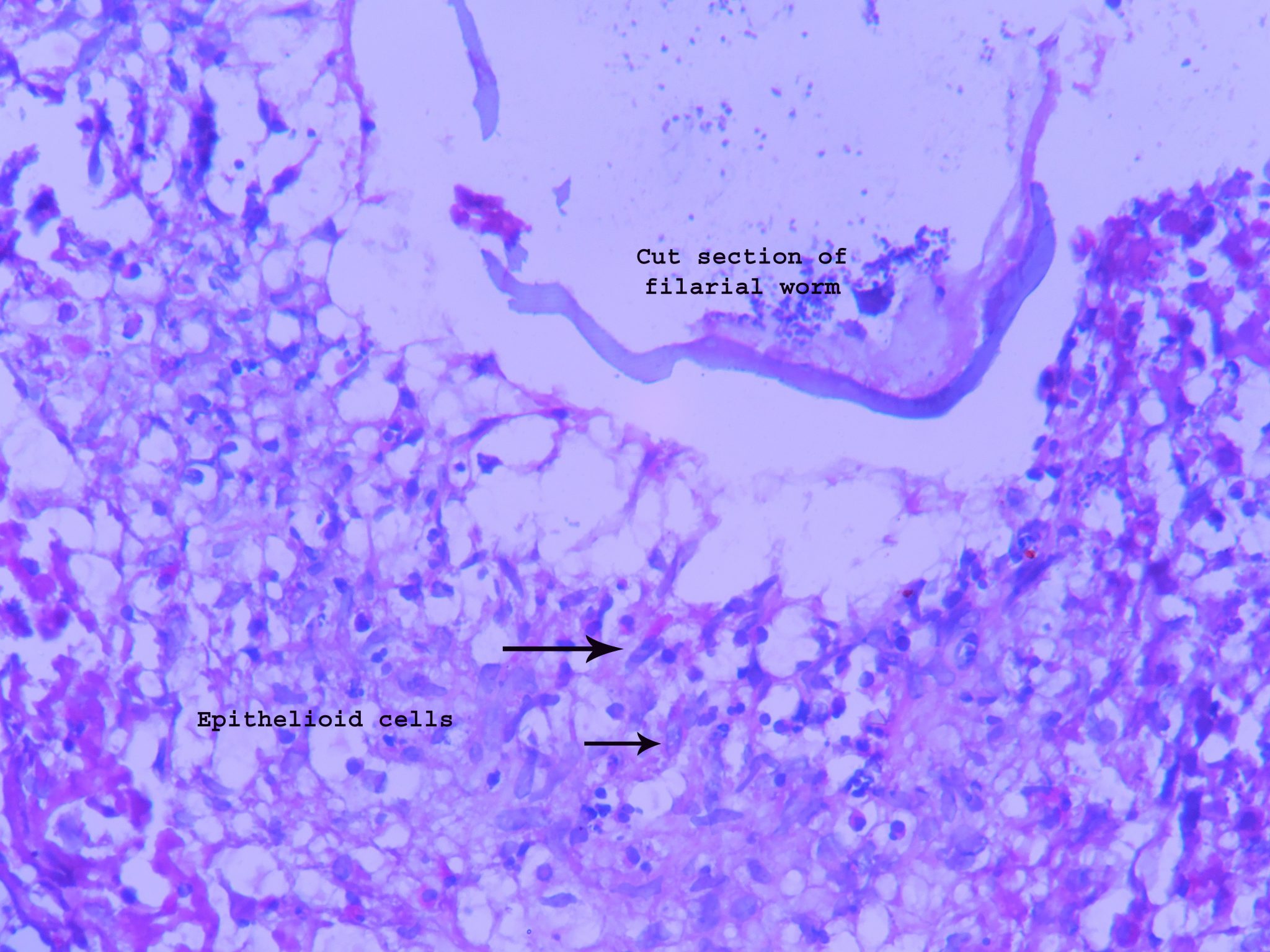 Lymph Node Filaria Histopathology Guru