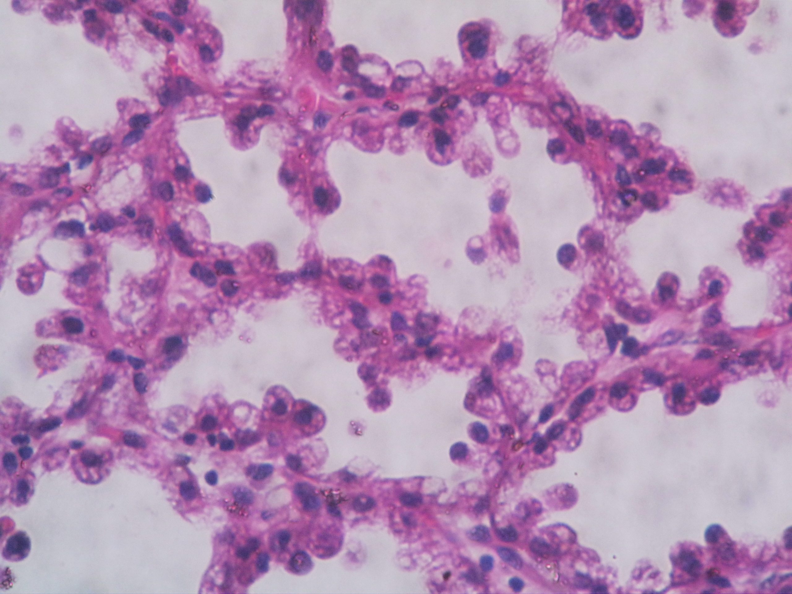 Fibroadenoma with secretary hyperplasia – Histopathology.guru