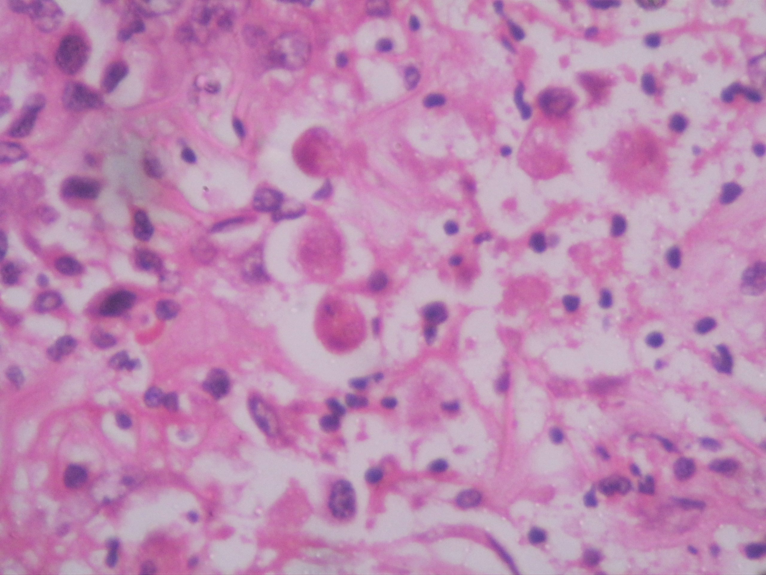 Entamoeba histolytica – Histopathology.guru