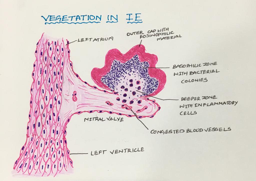 Infective Endocarditis Etiopathogenesis Morphology And Complications