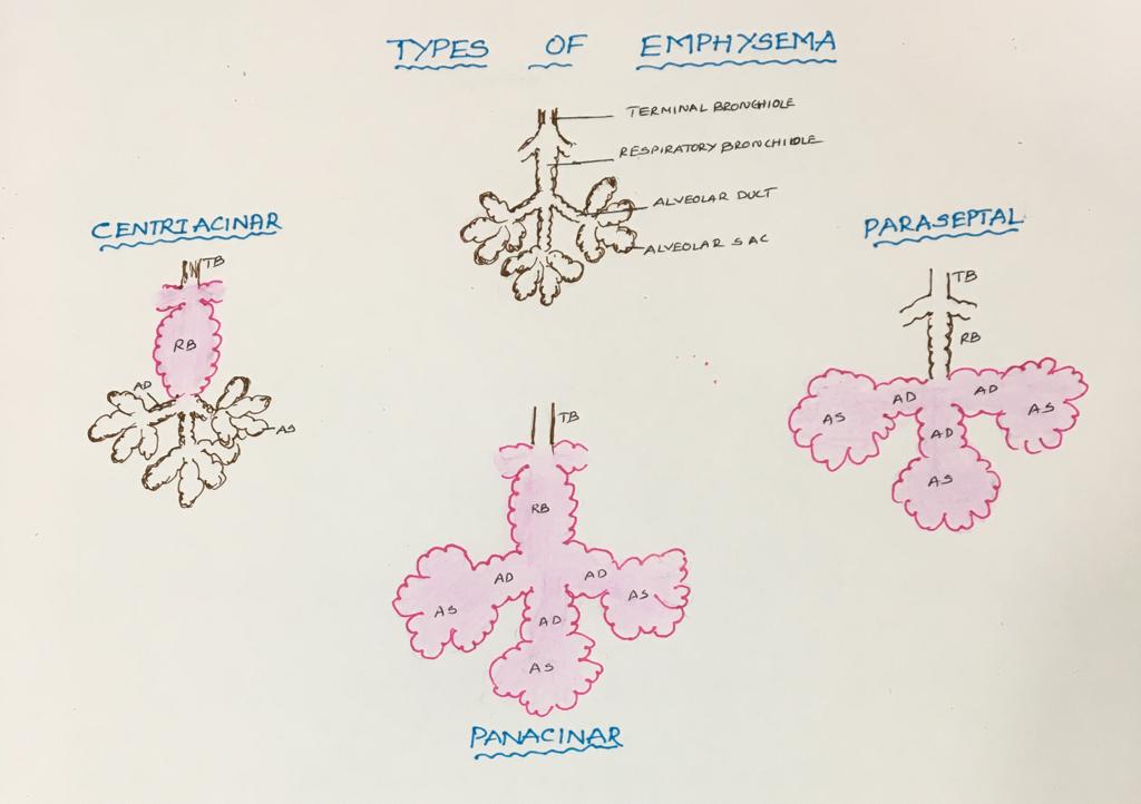 Types of Emphysema – Histopathology.guru