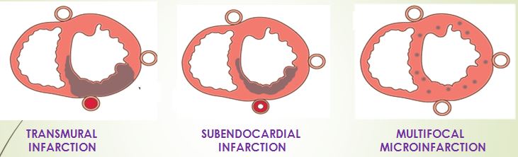 Myocardial Infarction – Histopathology.guru