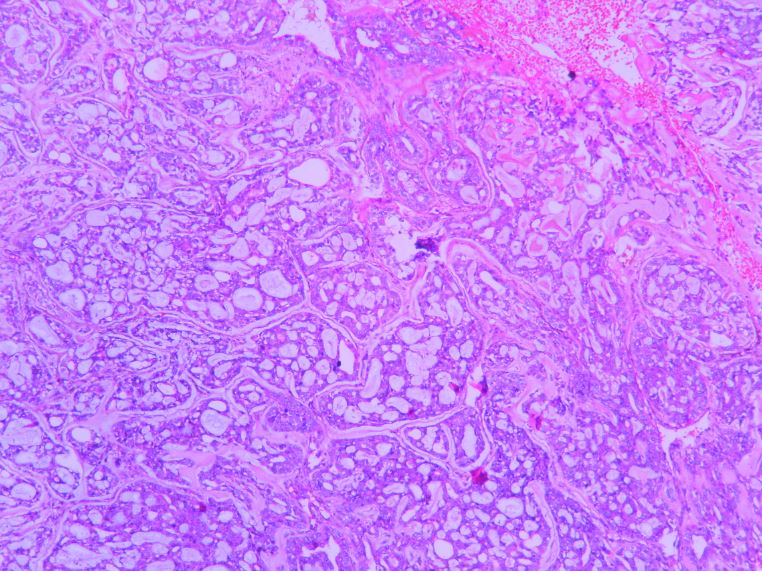 Adenoid cystic carcinoma – Histopathology.guru