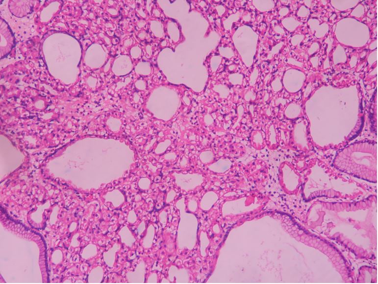 Fundic gland polyp – Histopathology.guru