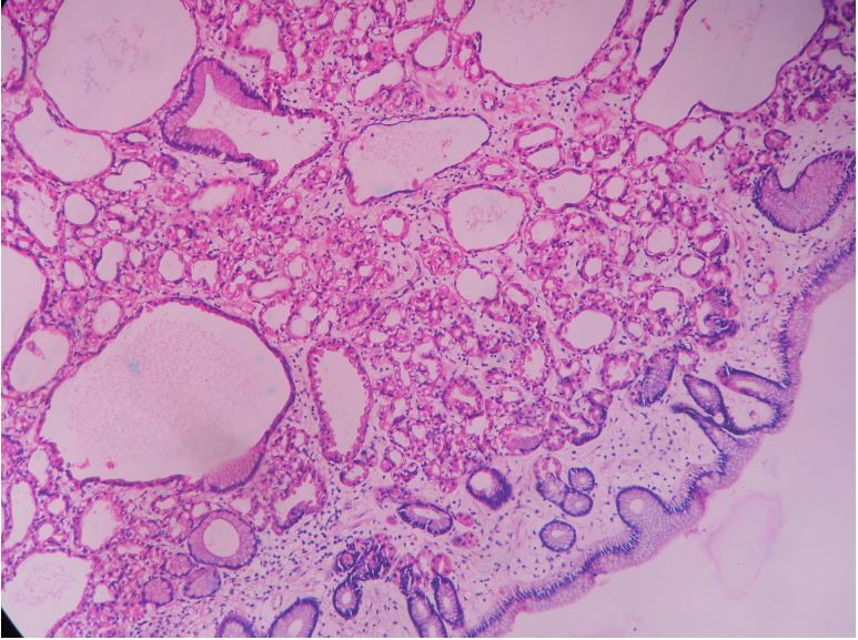 Fundic gland polyp – Histopathology.guru